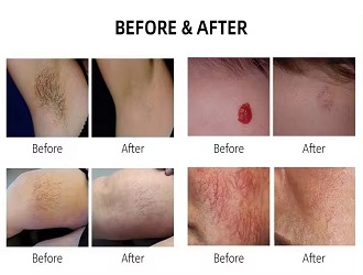 Precise Permanent Hair Removal – Long-pulsed fiber laser targets follicles for permanent hair reduction over a few treatments.